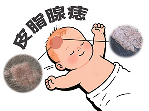 <strong>皮脂腺痣切除后多久恢复？哪个医院治疗效果好？</strong>
