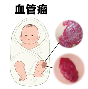 血管瘤严重吗？南京胎记治疗哪个好？